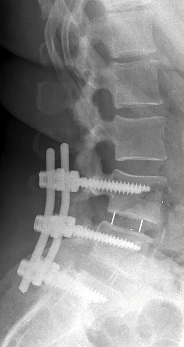 Имплант шейного отдела позвоночника. Межтеловой спондилодез Кейджем. Корпородез Кейджем. Задний спондилодез l5-s1. Артродез позвоночника спондилодез.