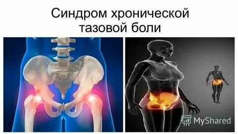 Хроническая тазовая боль код по мкб