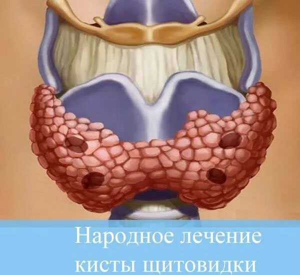 Киста щитовидной у мужчин. Киста щитовидной железы. Кистащетовидноижелезы. Щитовидная железа гисте.