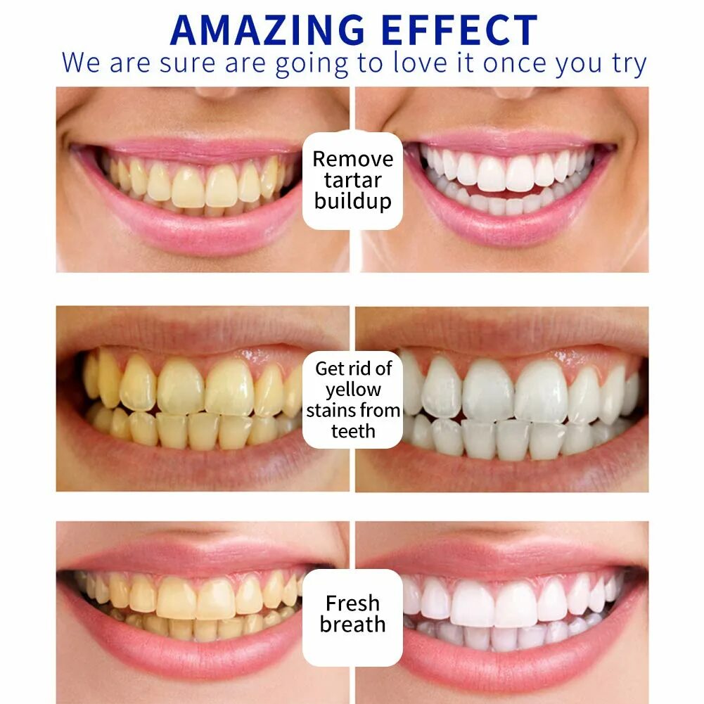 Отбеливание зубов. Желтые зубы отбеливание. Отбеливание зубов эффект.