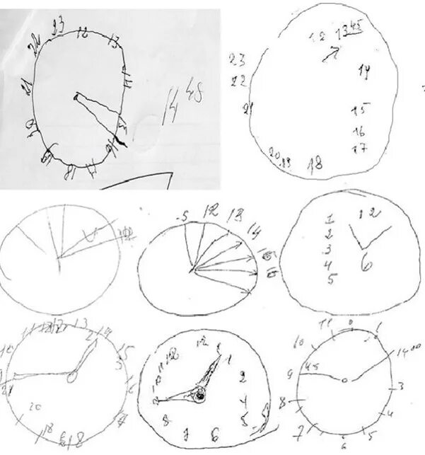 Рисование часов болезнь Альцгеймера. Тест рисования часов. Рисование часов при деменции. Тест рисования часов при деменции.