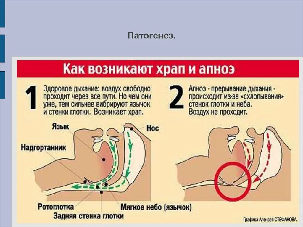 Ночное апноэ лечение. Синдром остановки дыхания во сне. Апноэ. Храп и синдром обструктивного апноэ сна.