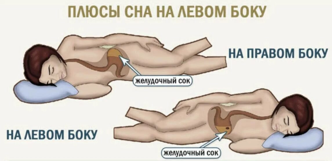 Сон на левом боку. Положение сна при беременности. Сон на левом боку. Сон на боку правильное положение. Сон при изжоге.
