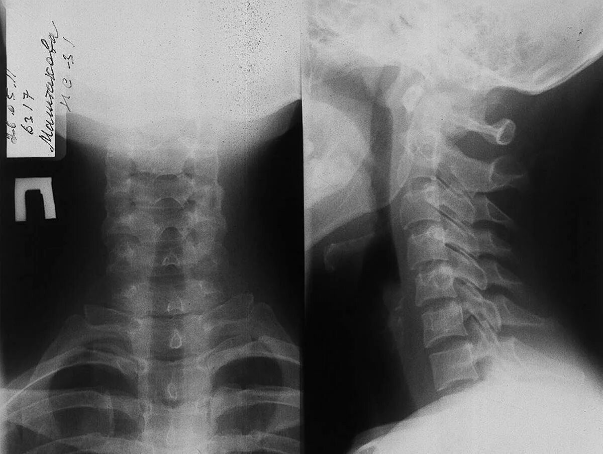 Рентгенография позвоночника в 2 х проекциях. Шейный отдел позвоночника рентген норма. Нормальный рентген шейного отдела позвоночника. Рентген шейного отдела в 2 проекциях. Рентгенограмма шейного отдела позвоночника норма.