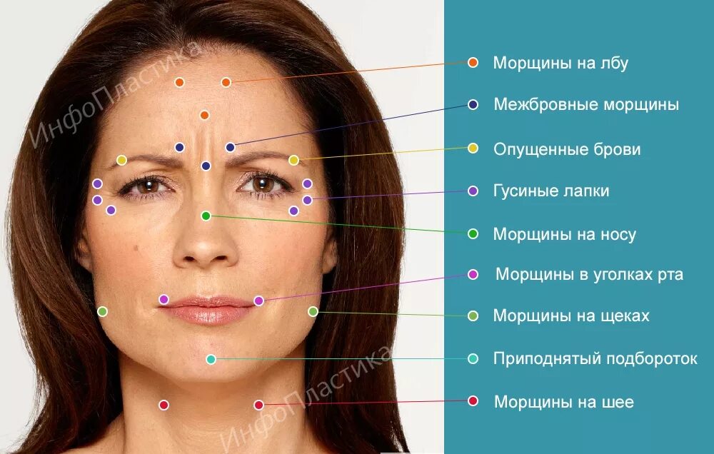 Где можно колоть. Схема введения ботокса в лоб. Точки введения ботокса на лице. Точки уколов ботокса на лице.