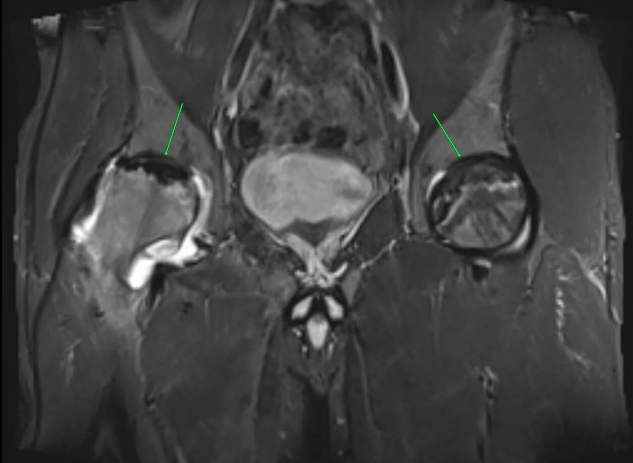 Асептический некроз кт. Степени асептического некроза головки бедренной кости мрт. Асептический некроз мрт. Асептический некроз головки бедренной кости мрт. Асептический некроз без операции