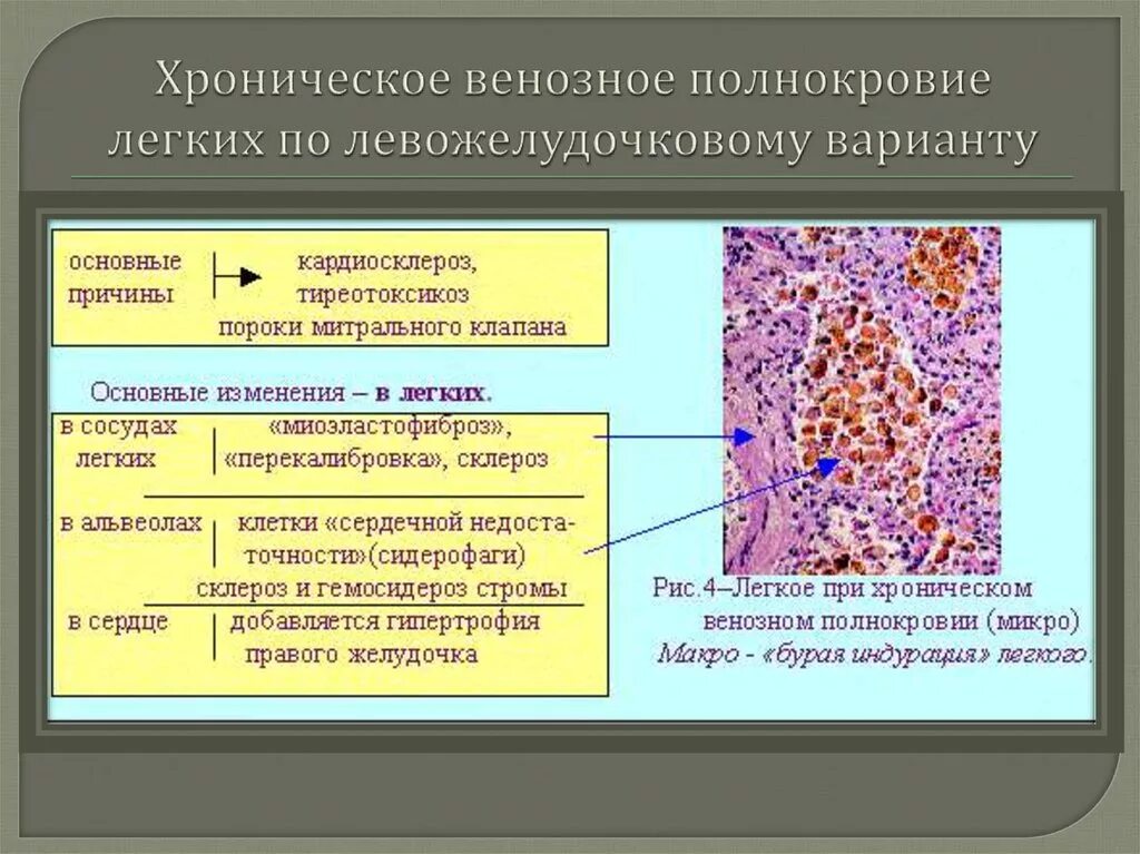 При хроническом венозном полнокровии в легких развивается. Хроническое общее венозное полнокровие. Хроническое общее венозное полнокровие морфология. Причины венозного полнокровия легких.