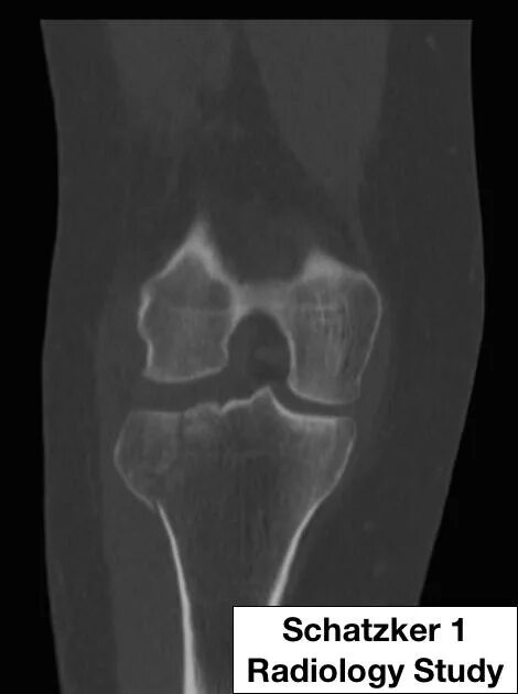 костная киста медиального мыщелка. трабекулярный отек мыщелков большеберцовой кости. трабекулярный отёк костного мозга. трабекулярный отек мыщелков большеберцовой кости. трабекулярный отек мыщелка бедренной кости.