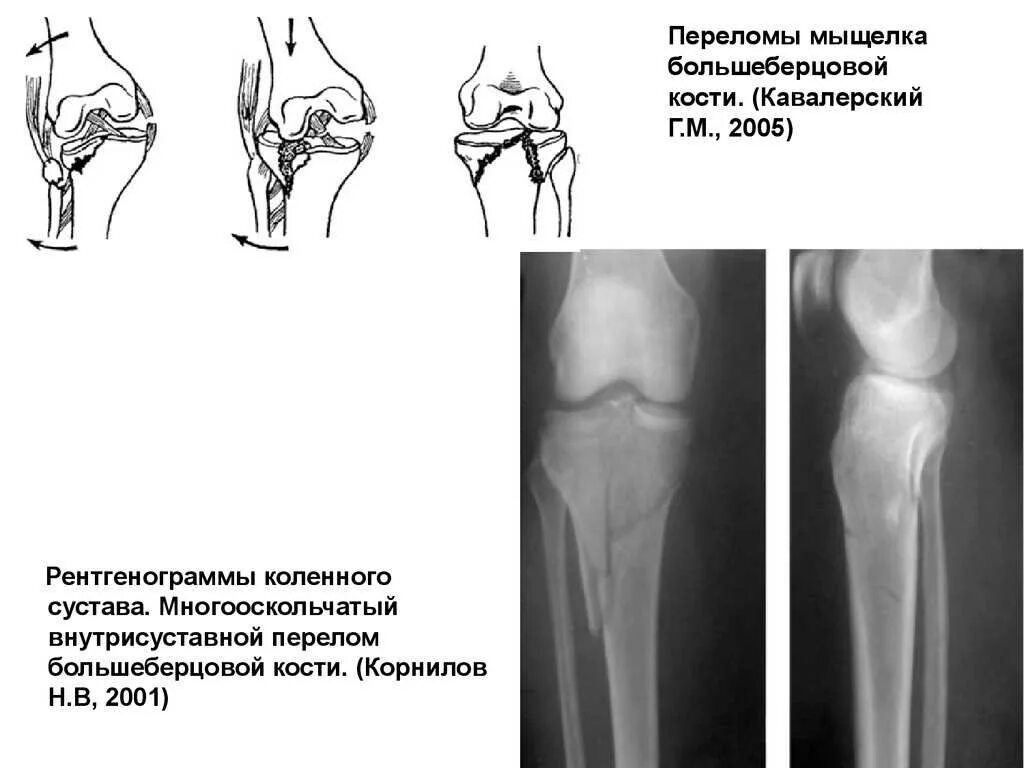 Лечение мыщелка. Перелом мыщелка берцовой кости коленного сустава. Классификация внутрисуставных переломов большеберцовой кости. Закрытый краевой перелом наружного мыщелка большеберцовой кости. Внутрисуставной перелом латерального мыщелка большеберцовой кости.