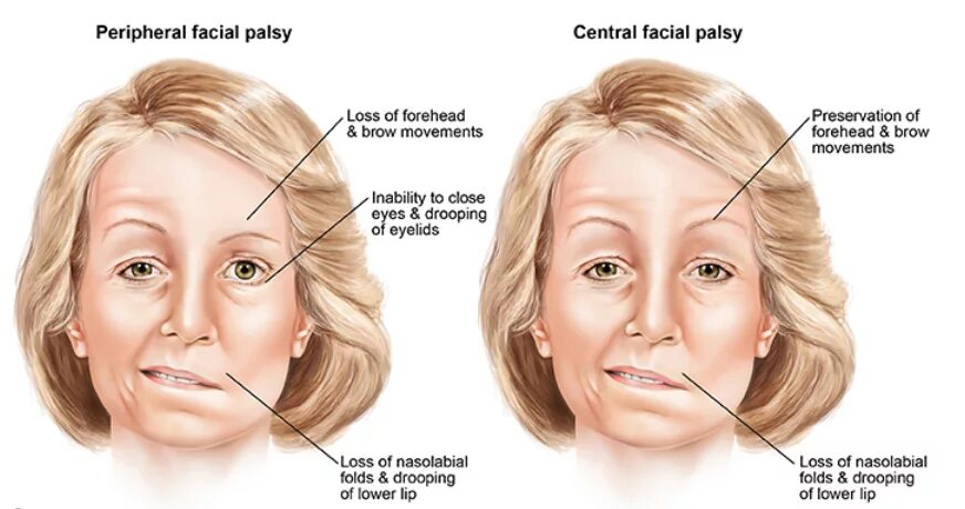 Центральный и периферический паралич лицевой мускулатуры. Центральный парез лицевого нерва при инсульте. Центральный и периферический парез лицевого нерва. Центральный паралич лицевого нерва симптомы. Центральный парез лицевого нерва