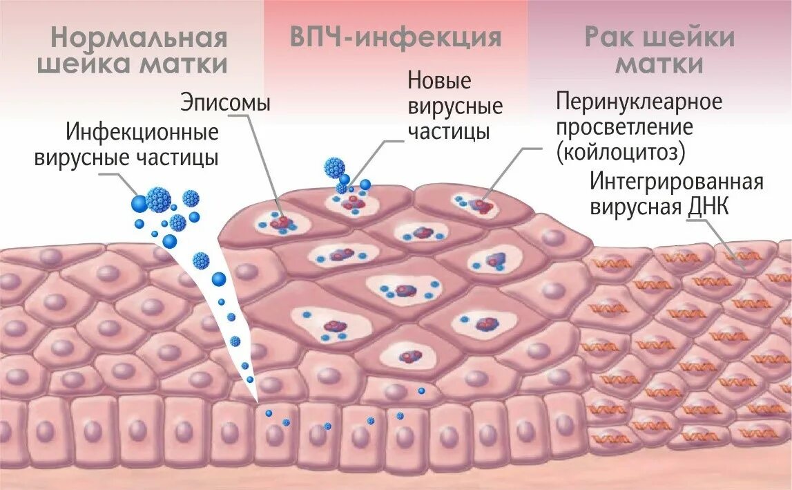 Впч и рак шейки. Виус папиломы человека. вирус папилломы человека (впч).