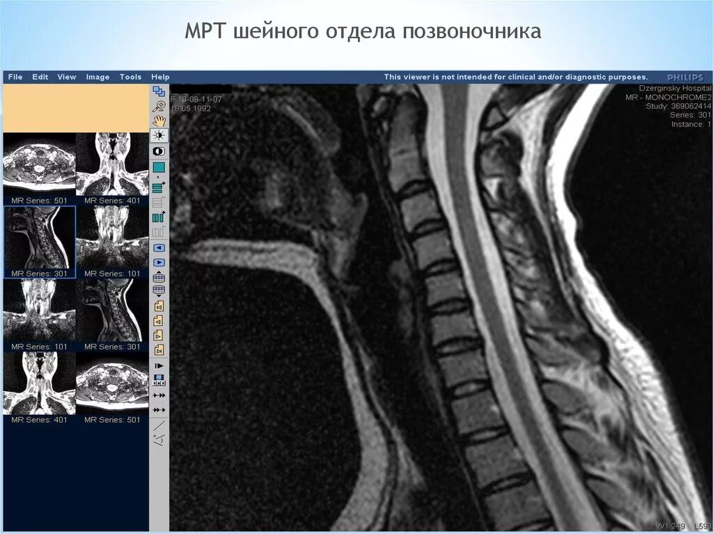 Грыжа шейного отдела позвоночника мрт. Мрт шейного отдела позвоночника патология. Кт шейного отдела позвоночника. Нормальное мрт шейного отдела позвоночника. Мрт шейного отдела позвоночника по времени