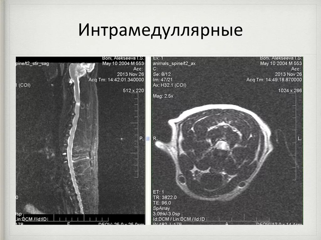 Экстрамедуллярная опухоль спинного мозга. Интрамедуллярное образование спинного мозга мрт. Интрамедуллярные новообразования. Интрамедуллярное поражение спинного мозга. Интрамедуллярные опухоли спинного