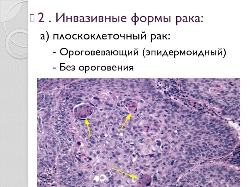 Плоскоклеточный рак дифференцировка. Плоскоклеточная карцинома g2. плоскоклеточная карцинома без ороговения. степени дифференцировки плоскоклеточной карциномы. плоскоклеточная дифференцировка что это такое.