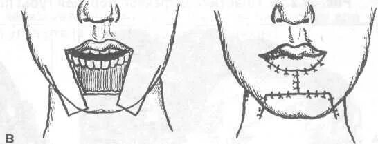 Операция нижней губы. Резекция нижней губы с пластикой дефекта по Брунсу. Пластика нижней губы по Брунсу. Пластика верхней губы по Седилло. Трапециевидная резекция нижней губы.