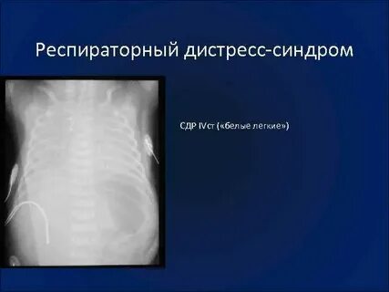 Респираторный дистресс новорожденных