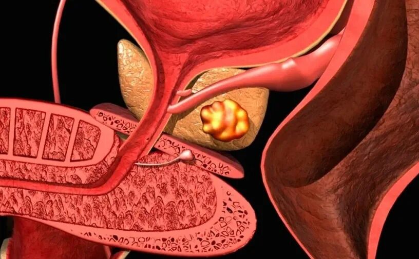 предстательной железы у женщин