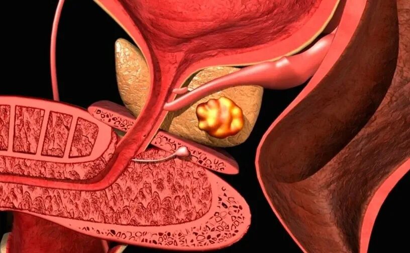 Камни предстательной железы. Ткань простаты