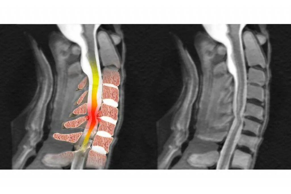 5) Миелопатия. Компрессионная миелопатия спинного мозга. Компрессионная миелопатия шейного отдела. Компрессионная миелопатия шейного отдела мрт. Компрессионная операция на позвоночнике