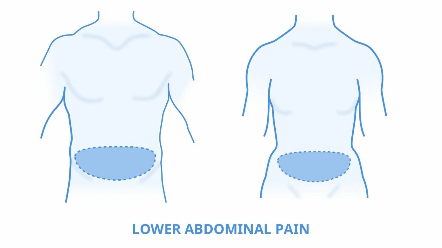 Немой живот на рентгенограмме. Картина немого живота. Lower abdomen. Иррадиация внизу живота