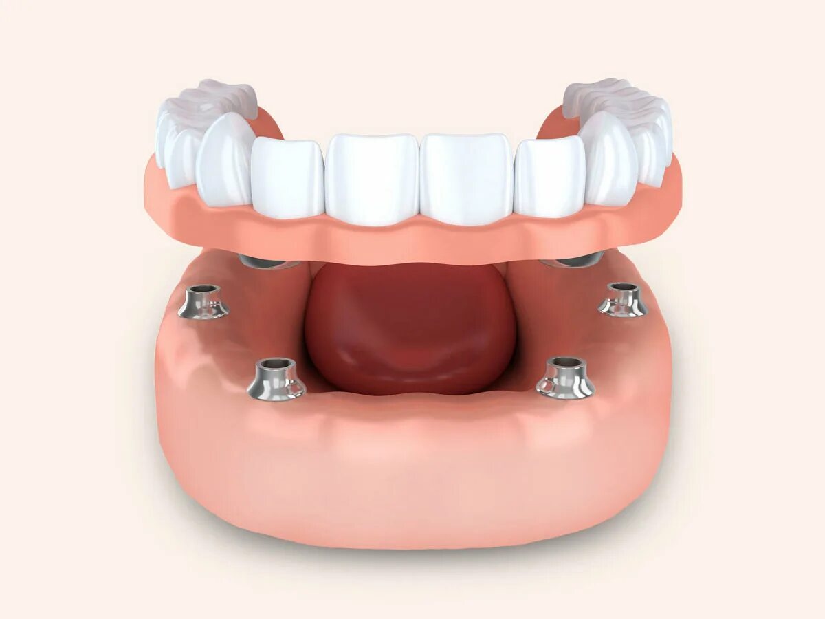 Имплантация челюсти на 4 имплантах. Условно-съёмный протез ( all-on-4).