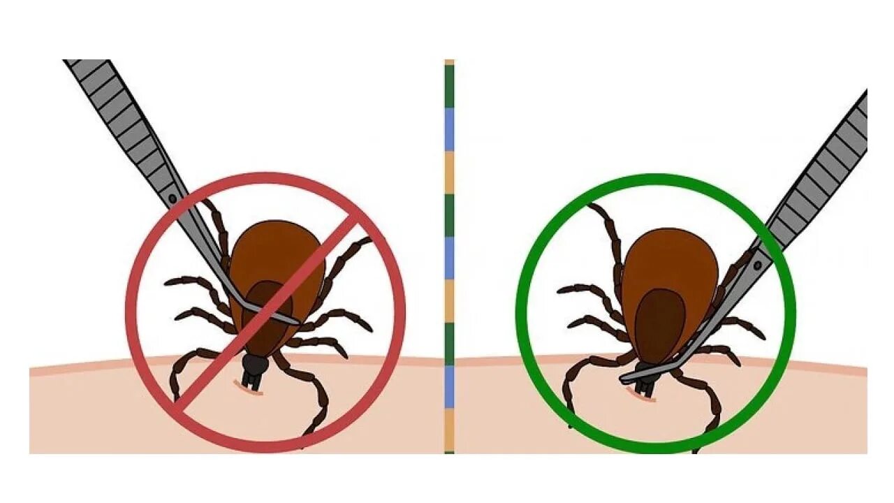Как вытащить клеща у человека в домашних. Способы извлечения клеща. Как удалить клеща пинцетом. Извлечение клеща пинцетом. Как вытащить клеща щипчиками.