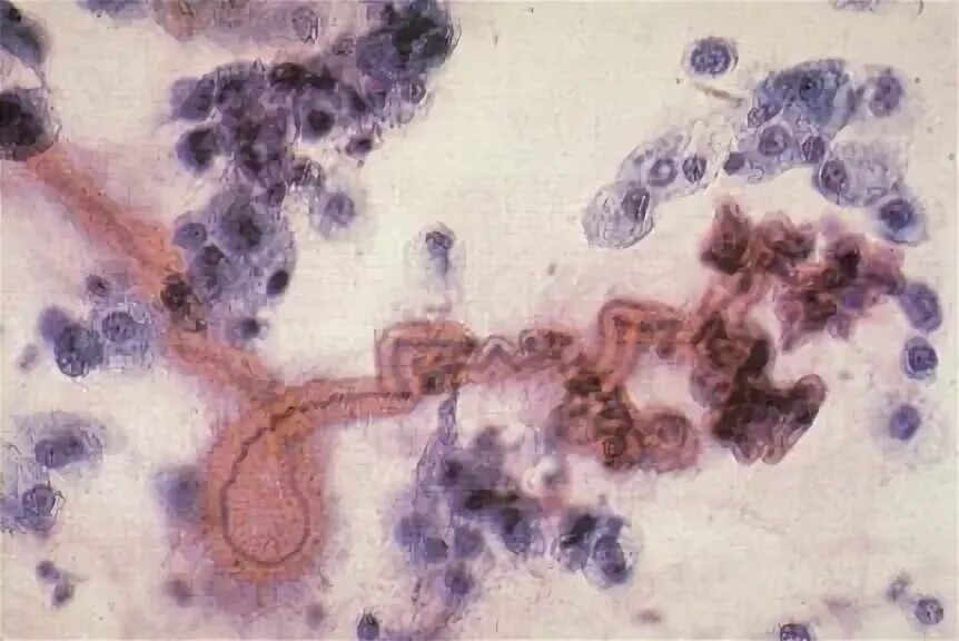 Куршмана в мокроте. Альвеолярные макрофаги в мокроте. Мерцательный эпителий в мокроте микроскопия. Спирали Куршмана микроскопия.