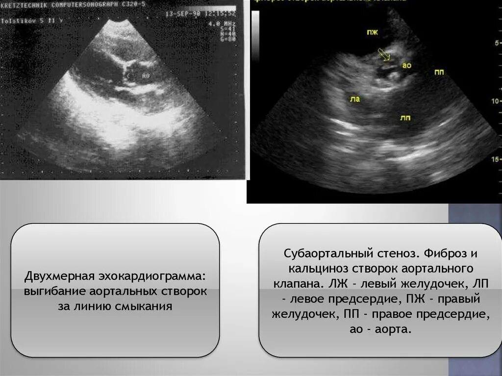 Кальцинат створки аортального клапана. Фиброз кольца аортального клапана что это. Аортальный стеноз кальциноз.