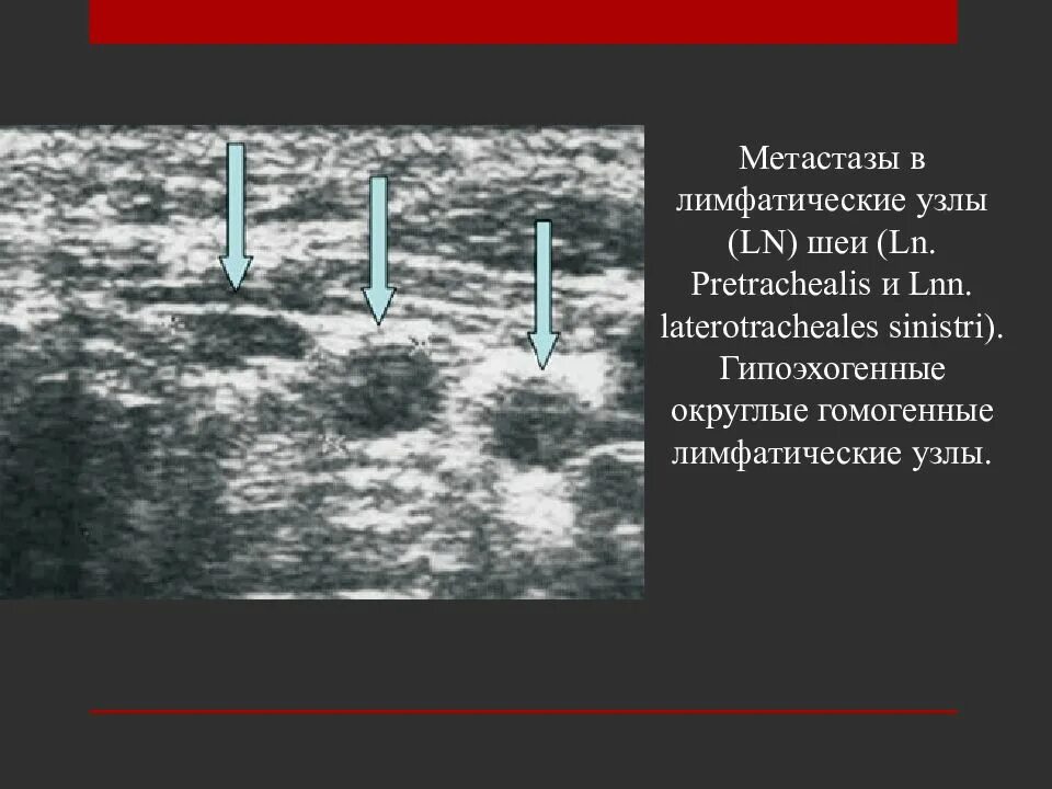 Метастатические лимфоузлы