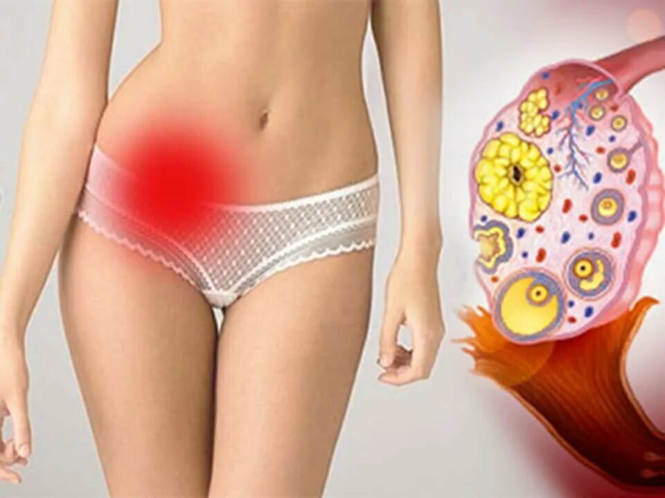 Заболевания яичников у женщин. Где болят яичники фото. Где болят яичники фото. Аднексит (воспаление придатков). Расположение матки и яичников.