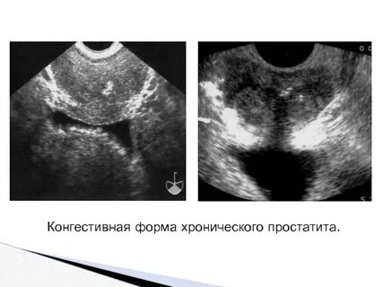 Предстательная железа узи подготовка