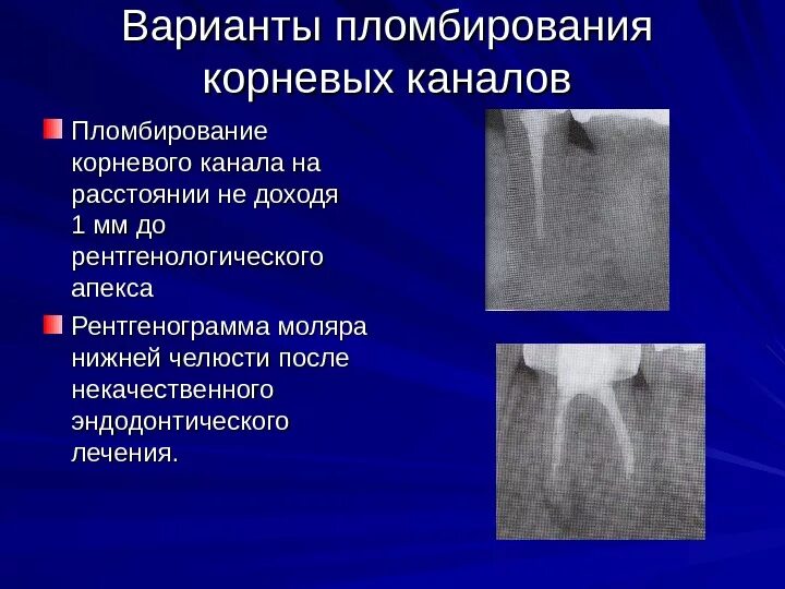 Обработка и пломбирование корневых каналов. Методики временного пломбирования корневых каналов. Система обтурации корневых каналов. Современные методы обтурации корневых каналов. Штифт для обтурации корневого канала.