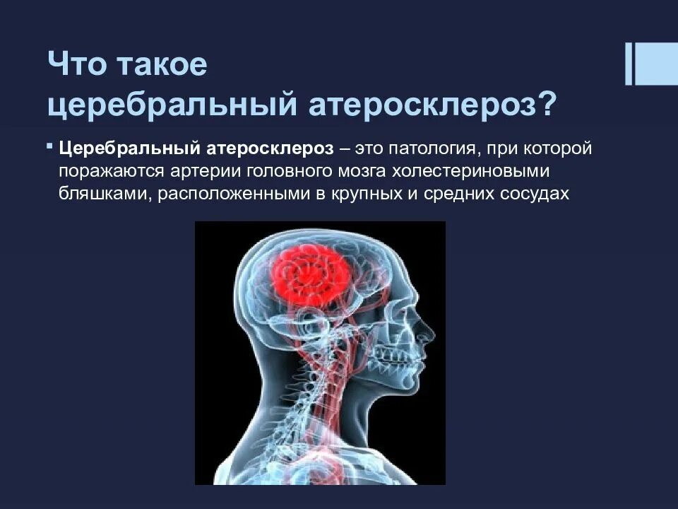 Заболевание сосудов мозга. Атеросклероз церебральных сосудов симптомы. Атеросклероз артерий головного мозга. Атеросклеротическое поражение сосудов головного мозга. Атеросклеротические поражения артерий головного мозга.