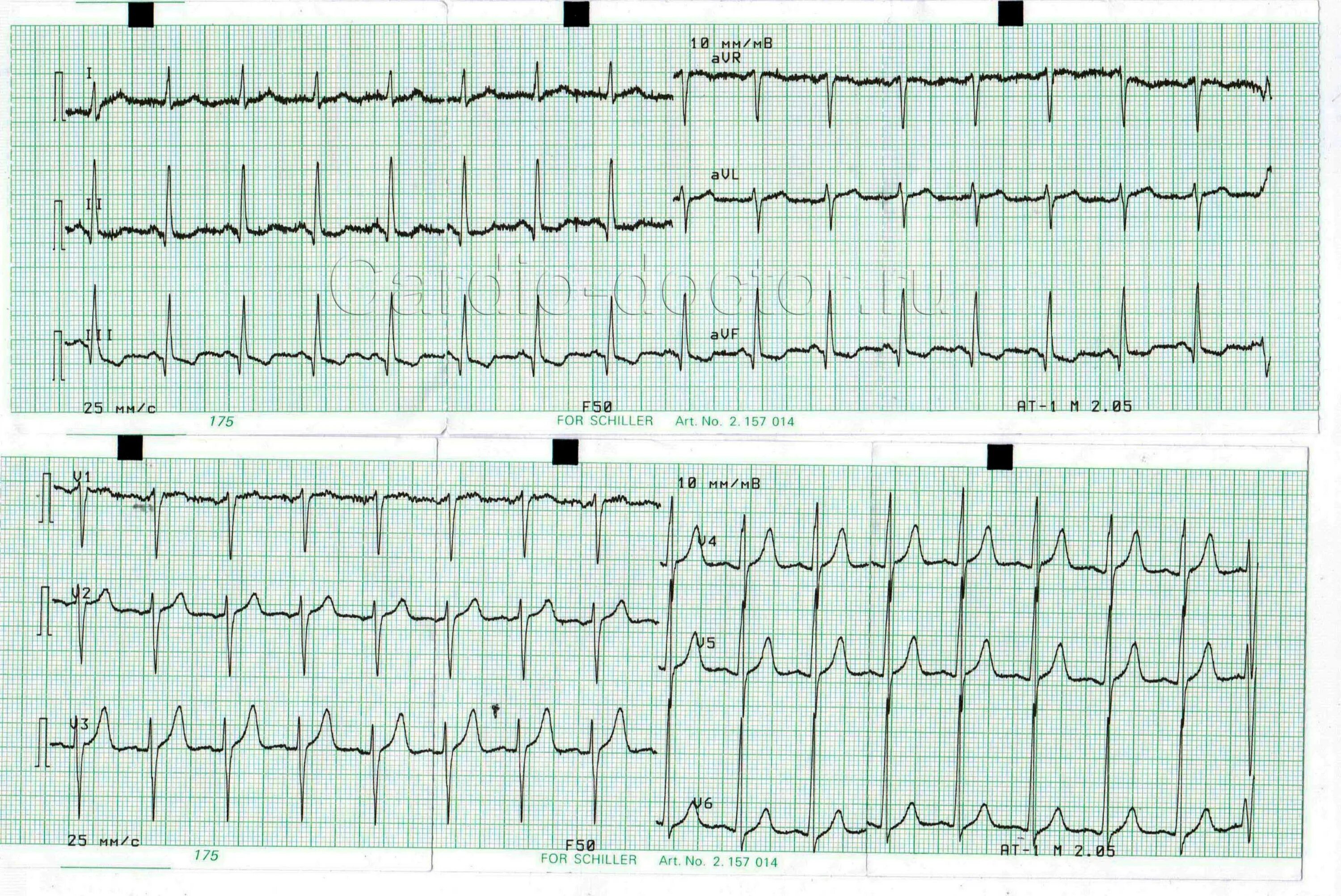 Тахикардия. Пароксизмальная синусовая тахикардия. Тахикардия в минуту. Нарушение сердечного ритма синусовая тахикардия. Экг при синусовой тахикардии сердца.