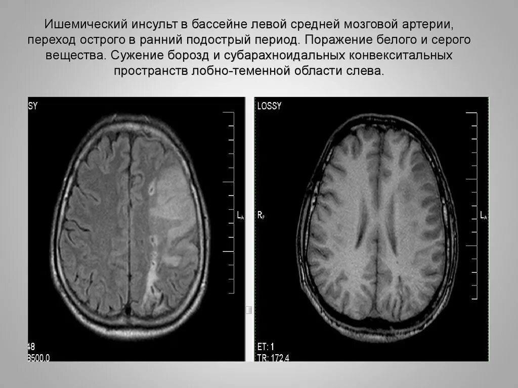 Левая средняя мозговая артерия инсульт. Инсульт в бассейне средней мозговой артерии кт. Мрт ишемический инсульт в бассейне левой средней мозговой артерии. ОНМК В бассейне левой средней мозговой. Ишемический инсульт височной доли клиника.