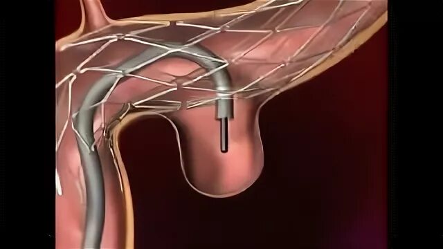 Стентирование видео. Эндоваскулярное стентирование аневризмы. Эндоваскулярная эмболизация сосудов. Эмболизация аневризмы. Стентирование сосудов головного мозга.