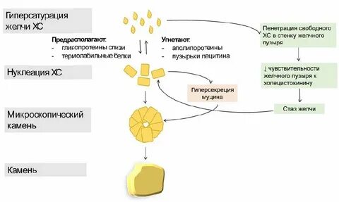 Образование желчных камней
