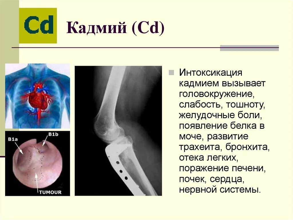 Хроническое отравление кадмием. Отравление кадмием симптомы. Кадмий отравления симптоматика.