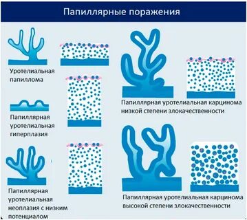 Неинвазивная low grade