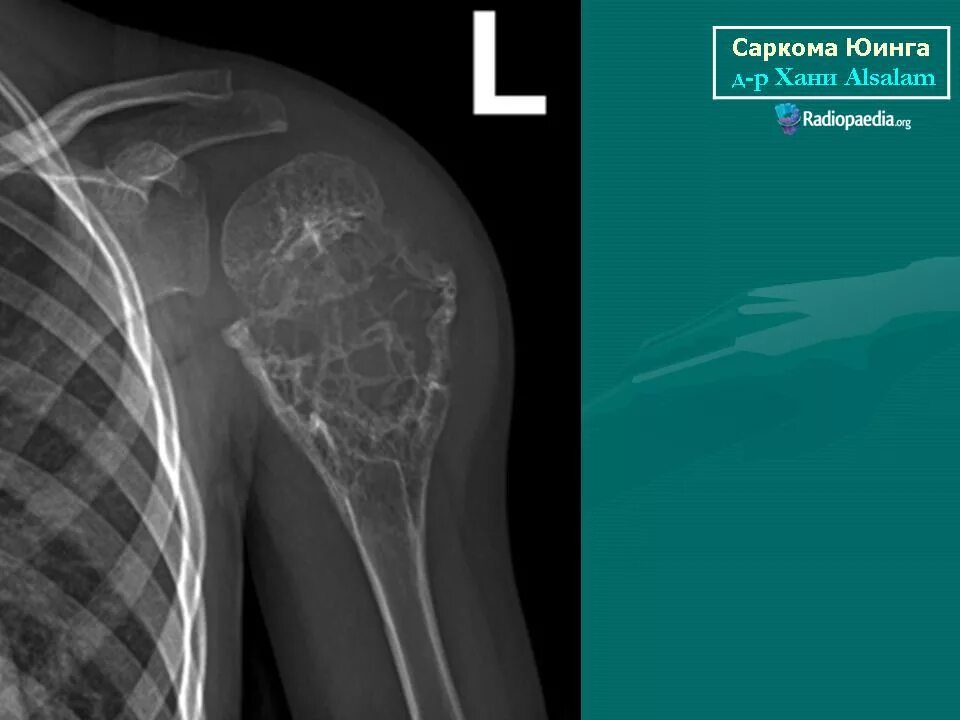 Диагноз саркома. Саркома Юинга плечевой кости рентген. Саркомы костей рентген. Внескелетная саркома Юинга. Саркома мягких тканей на рентгене.