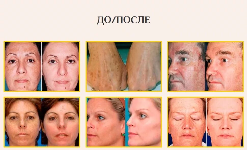 До и после пигментных пятен отзывы Breylee витамин C 20% отбеливающий крем для лица кожи ремонт веснушки темные пят