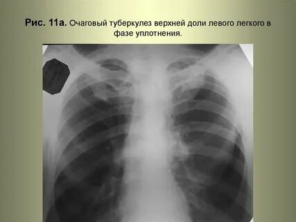 Очаговый легких в фазе инфильтрации
