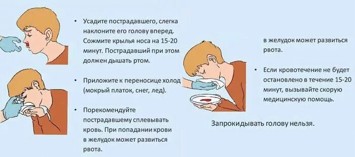 Сильное течение из носа. Алгоритм при носовом кровотечении. Остановить носовое кровотечение у ребенка. Причины носового кровотечения.