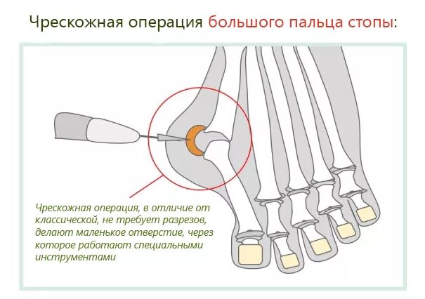 Реабилитация халюс вальгус стопы. Халюс ва. Вальгусная деформация 1 пальца. Вальгус косточка на большом пальце. Операция на большом пальце ноги косточка отзывы.