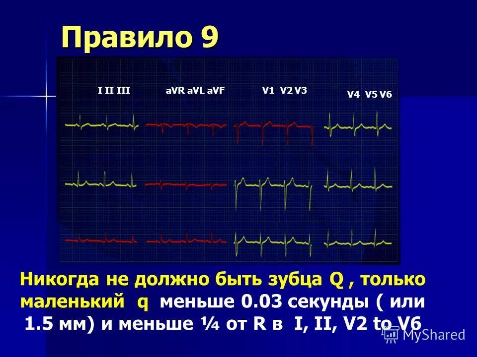 Норма экг в отведениях v1 v2. Экг v1 v2 v3 v4 v5 v6 расшифровка. V1 v3 отведениях. Экг 2 отведение патологии. Норма экг в v1-v2.