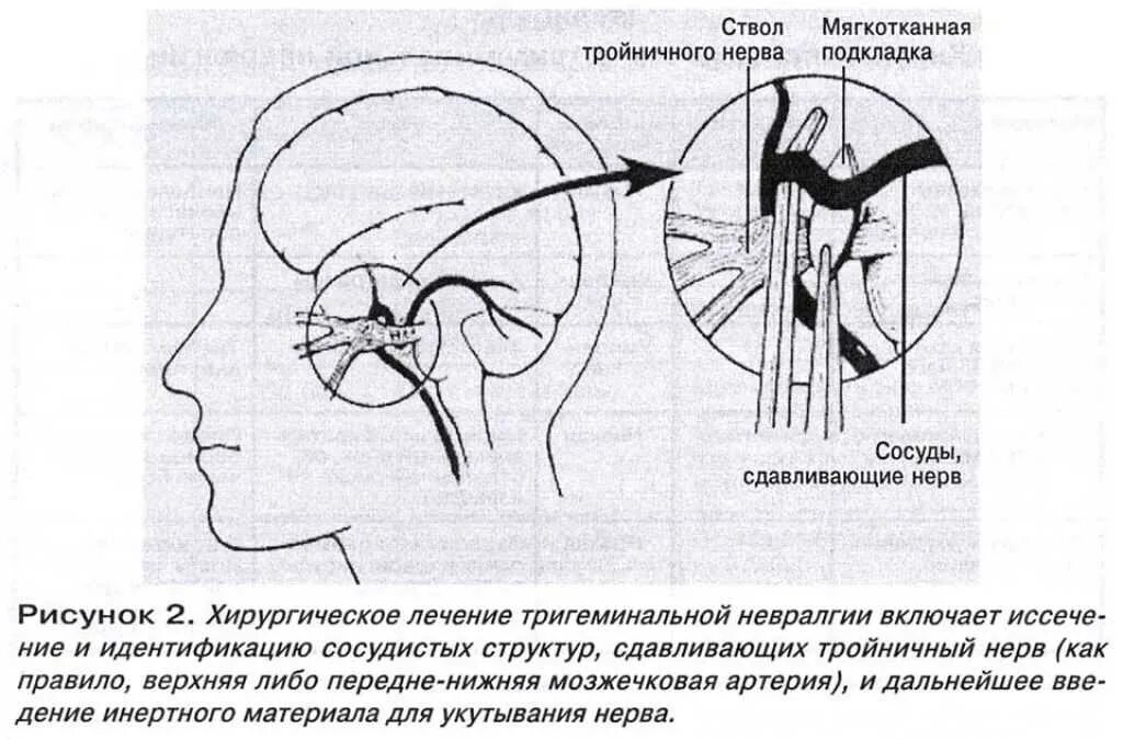 Схема лечения неврита тройничного нерва. Клиника поражения первой ветви тройничного нерва. Невралгия тройничного нерва курковые зоны. Операция при невралгии тройничного нерва. Тройничный нерв лечение