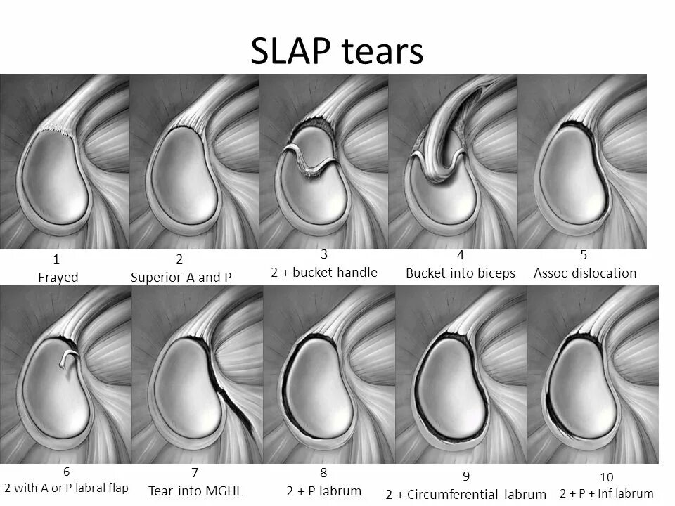 Slap разрыв классификация. Слэп синдром плечевого сустава. Slap повреждение плечевого. Slap синдром плечевого сустава мрт.