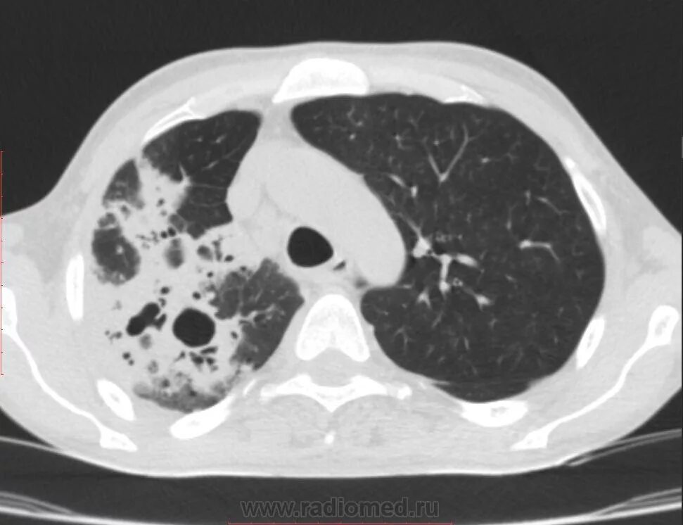 Кт 4 легкие. Пневмония на кт. Аспирационная пневмония кт картина. Кт-4 пневмония ковидная.