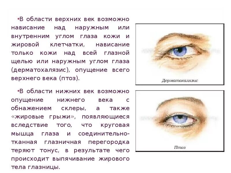 Дергается нижнее левое веко что делать. Птоз века левого глаза. Односторонний птоз верхнего века причины. Птоз верхнего века степени. Причины дергания глаза верхнего века.