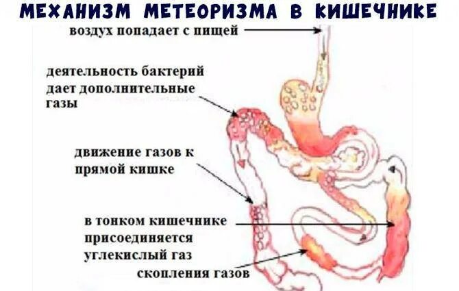 Сильное вздутие в области желудка. При газообразовании в кишечнике. Вздутие живота метеоризм. Сильное вздутие живота и газообразование.